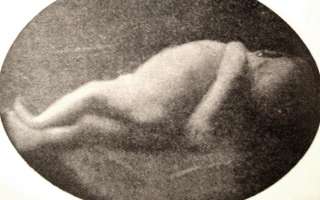 GRIPPING WEIRD Antique 1907 FREAKS PHOTO MEDICAL BOOK Amazing Breast 